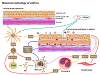 Molecular pathology of Asthma PPT Slide